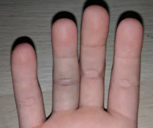 Sprained Finger