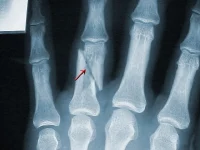 Fractured Finger