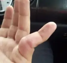 Dislocated Finger