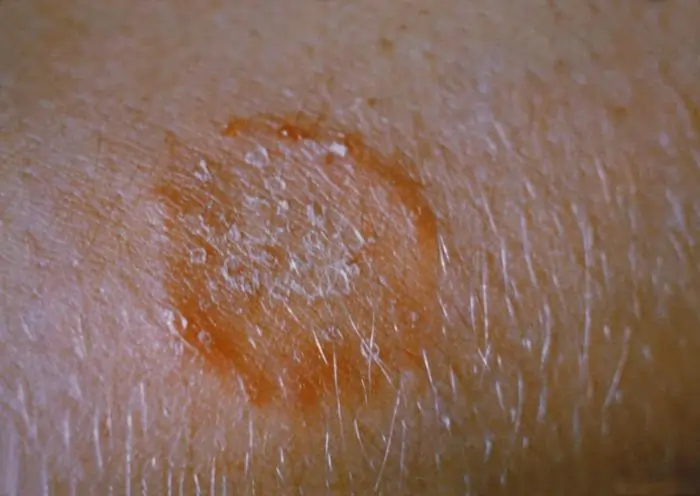 Ringworm infection on the arm