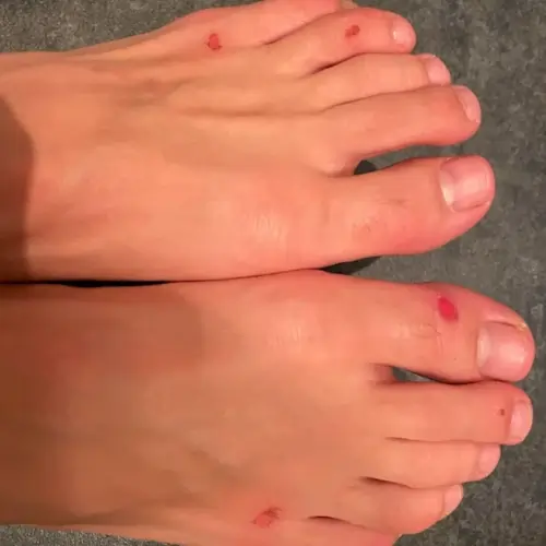 BJJ Mat Burn on the Feet and Toes